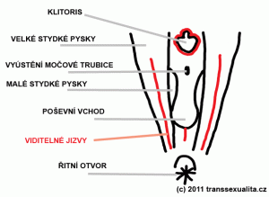 Schema stavu genitálu po první opraci v Motole